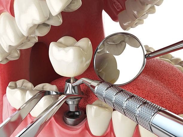Best Emergency Dentist for Lost Fillings or Crowns in Mount Healthy, OH